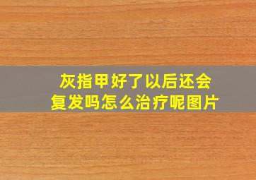 灰指甲好了以后还会复发吗怎么治疗呢图片